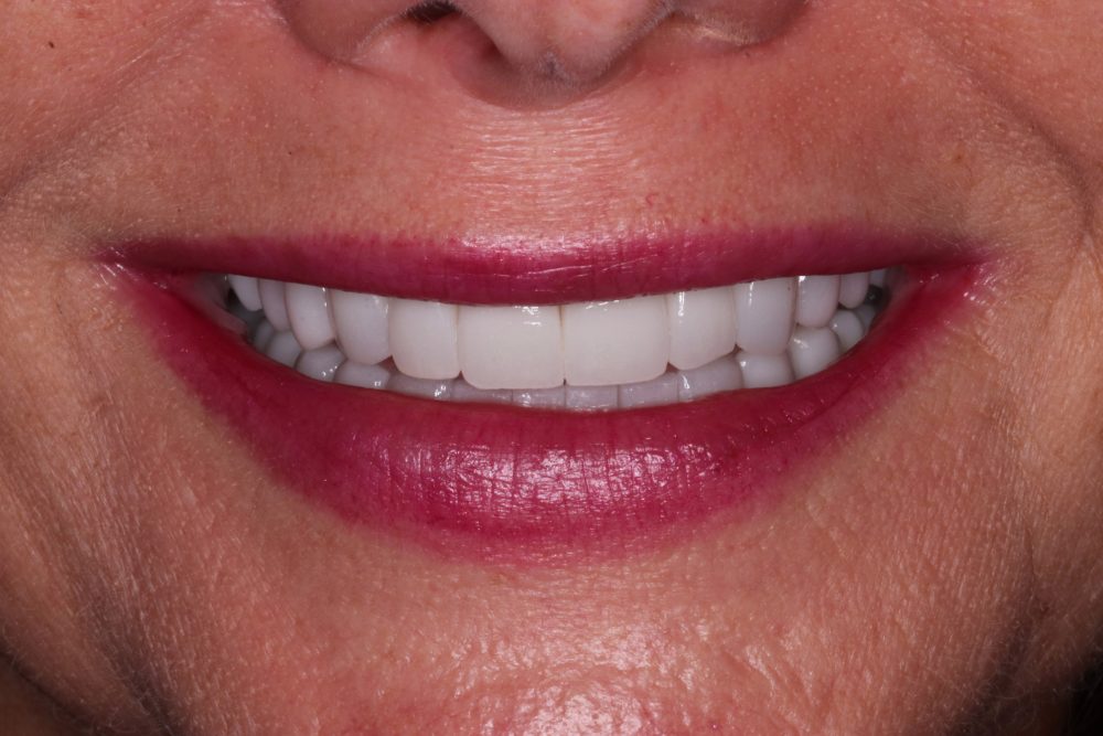 Janice's radiant smile showcasing porcelain crowns after full mouth reconstruction and crown lengthening treatment at PGA Dentistry.
