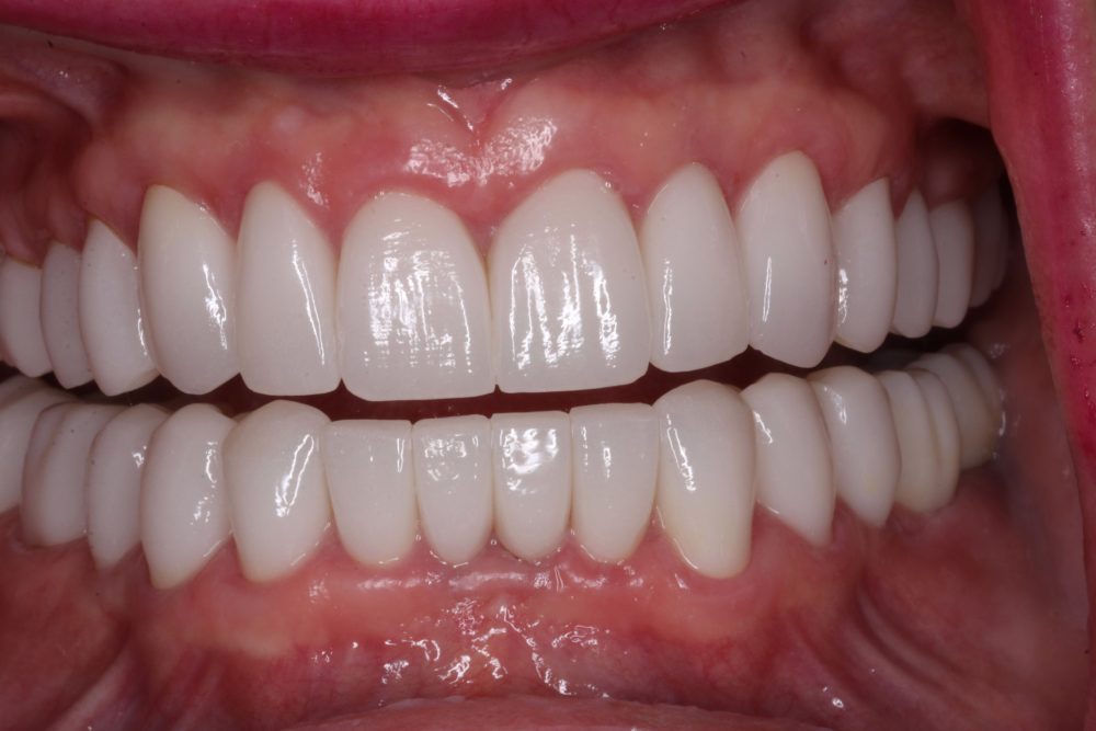 Close-up of a patient's smile showcasing bright, white teeth after full mouth reconstruction, highlighting dental crowns and healthy gum tissue, relevant to PGA Dentistry's restorative services.