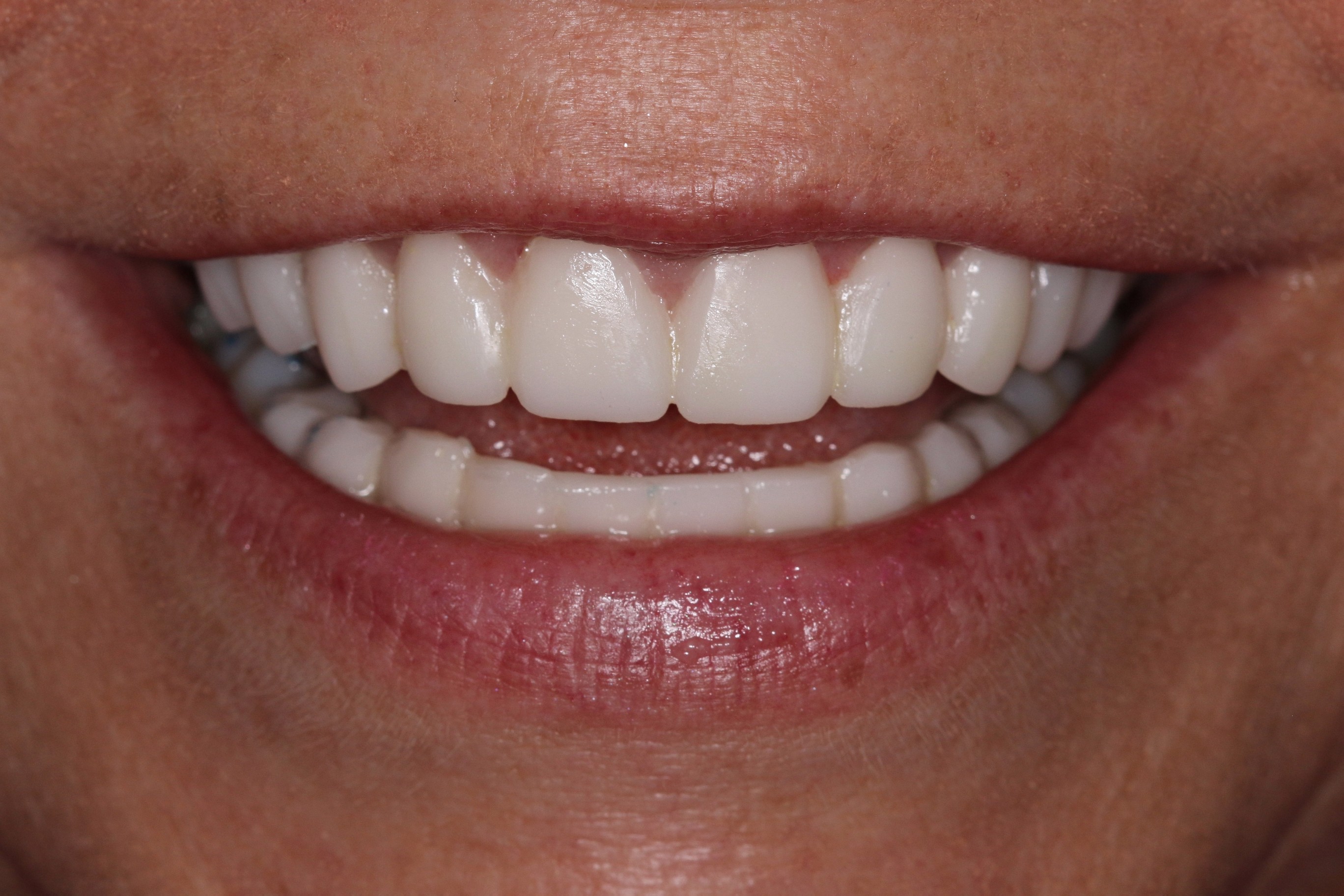 Close-up of a smile showcasing bright, natural-looking porcelain veneers, highlighting straightened front teeth and a gap correction, reflecting a youthful and confident appearance.