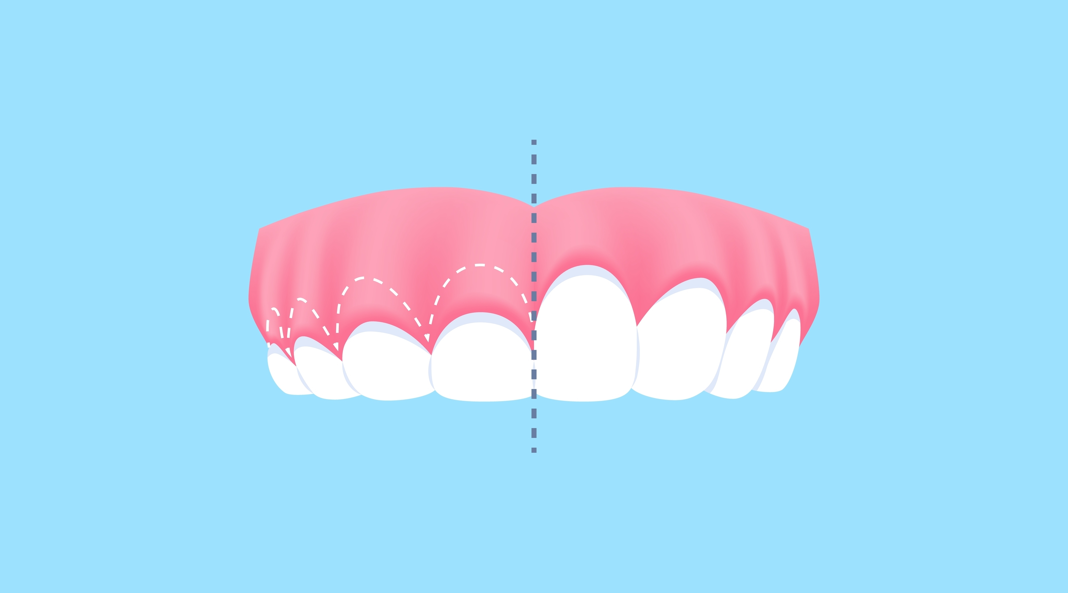 gummy smile; before and after